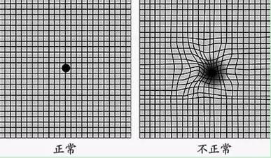 视网膜炎视物变形.png